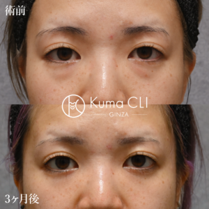 クマクリ 症例写真 裏ハムラ法evo＋ナノリッチ 術前術後の比較